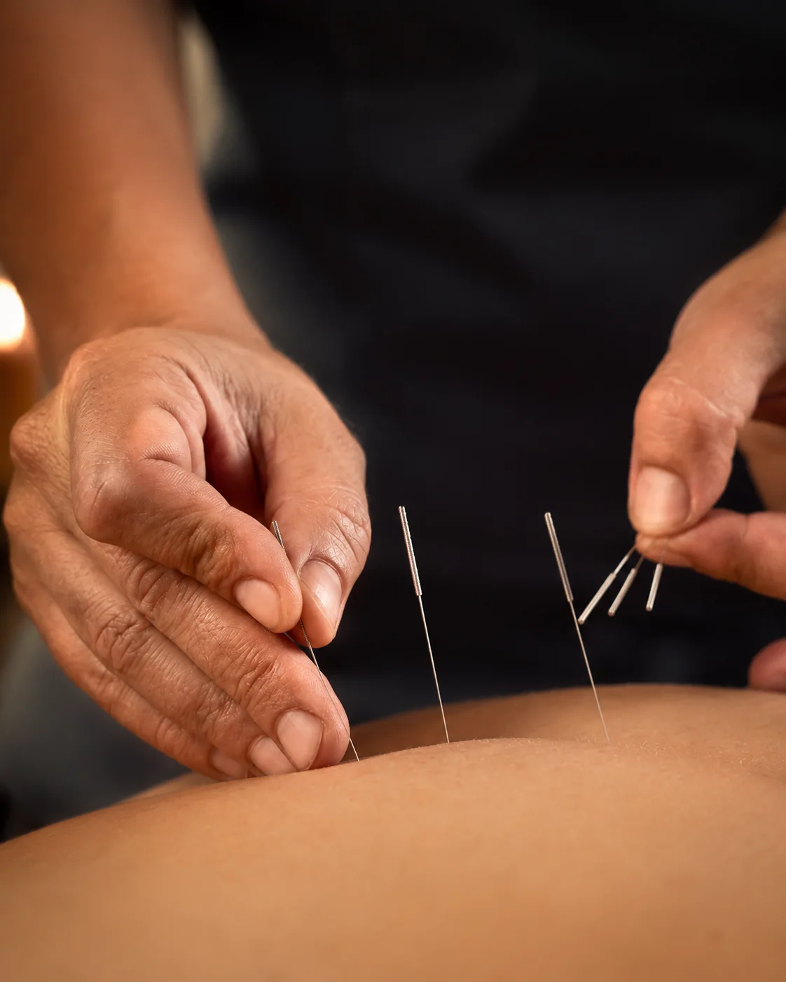 Aplicación de agujas de acupuntura durante una sesión